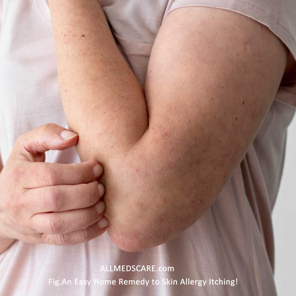 Skin allergy itching- Assured Relief!